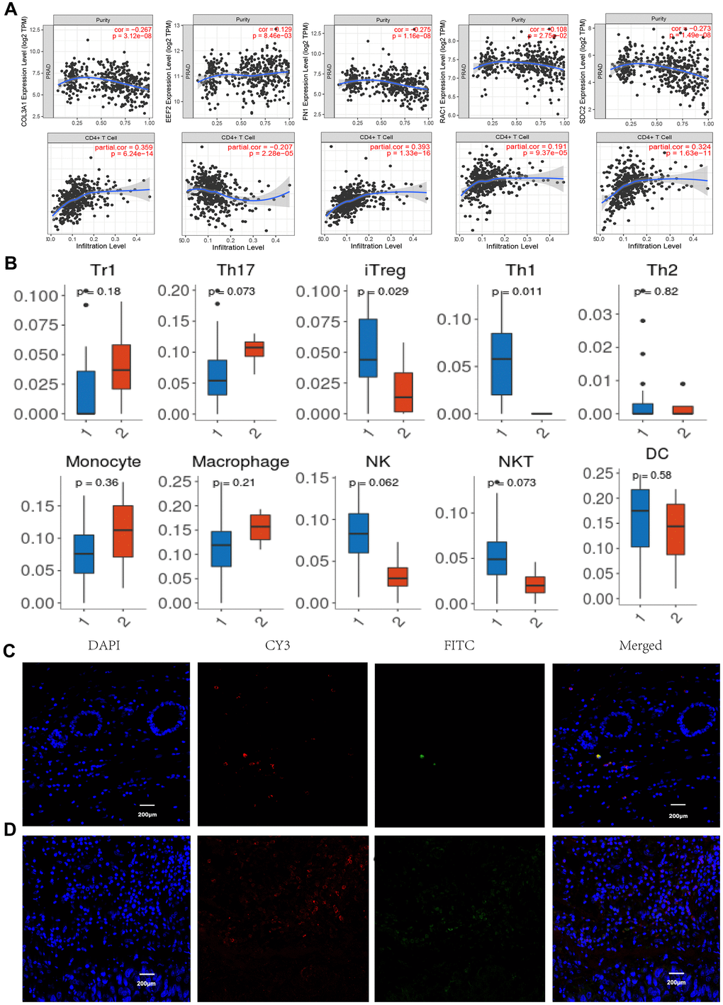 Immune infiltration and immunofluorescence identification. (A) Correlation of gene expression levels of COL3A1, EEF2, FN1, RAC1, and SDC2 with tumor purity and CD4+ T cells. (B) Tumor infiltrating lymphocytes profiles in the BM PCa (1. BM tumor, 2 normal tissues). Normal tissue (C) and BM tumor (D) immunofluorescence labeling for CD4 (red) and FOXP3 (green), as well as merged images. (n =6, P 