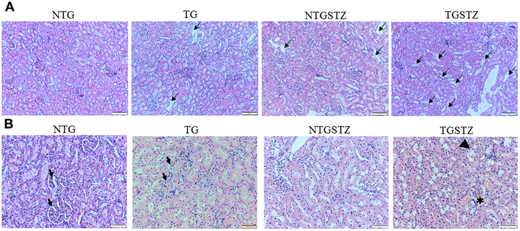 Effects of cardiac specific IGFIIRα overexpressing DM rats in renal cellular architecture. (A) H and E staining shows changes in renal cellular architecture in Non-transgenic rats (NTG), transgenic (TG), NTG-streptozotocin induced diabetes model (NTGSTZ), TG streptozotocin induced diabetes model (TGSTZ). TG rats show renal tubular damages (arrows) and STZ induced DM in TGSTZ elevates the damages. (B) Glomeruli of TG rats showed a slight hypertrophy and mesangial expansion (Arrow). NTGSTZ groups showed contraction of glomeruli. TGSTZ rats show higher degree of glomeruli infiltration (*) and damages in addition TGSTZ rats show atrophy and degeneration of renal tubules (arrow head). Scale bar represent 100 μm at 40x magnification.