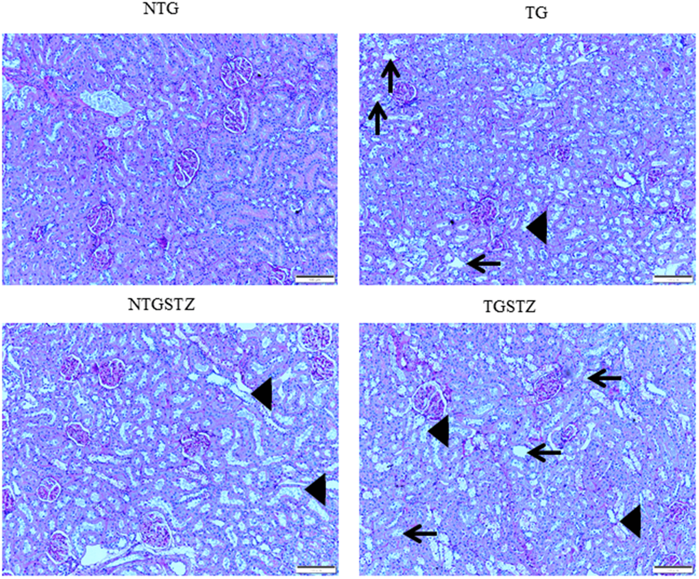PAS staining to show changes in the tubular structures. PAS staining show differences between Non-transgenic rats (NTG), transgenic (TG), NTG-streptozotocin induced diabetes model (NTGSTZ), TG streptozotocin induced diabetes model (TGSTZ). STZ challenge triggered vacuolization (arrow) and degeneration of renal tubular epithelium NTGSTZ. TG rats that generally showed tubular dilation (arrow head) also showed higher levels of STZ induced vacuolization and degeneration. Scale bar represent 100 μm at 40 x magnification.