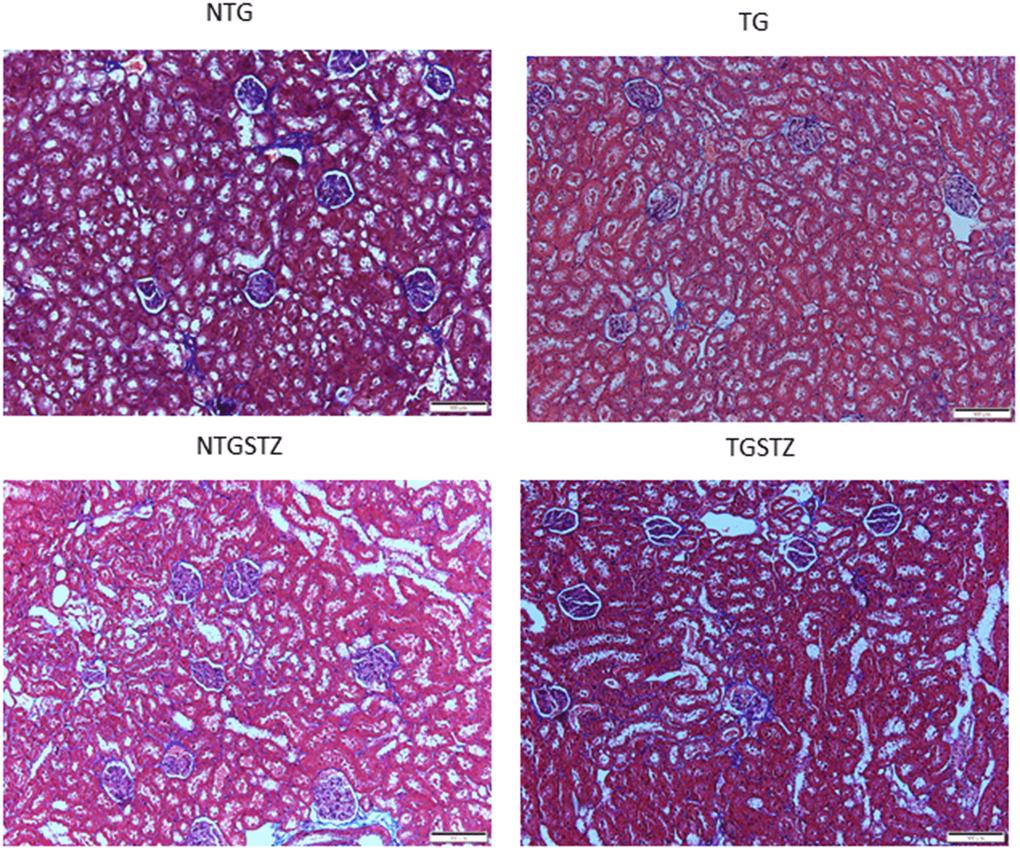 Effects of cardiac specific IGFIIRα overexpressing DM rats on interstitial collagen. Masson’s trichrome staining (n=3) show difference in collagen accumulation in Non-transgenic rats (NTG), transgenic (TG), NTG-streptozotocin induced diabetes model (NTGSTZ), TG streptozotocin induced diabetes model (TGSTZ). NTGSTZ induced DM rats show collagen accumulation (blue stain). TG rats show elevated interstitial collagen accumulation compared to NTG and NTGSTZ rats. Scale bar represent 100 μm at 40 x magnification.