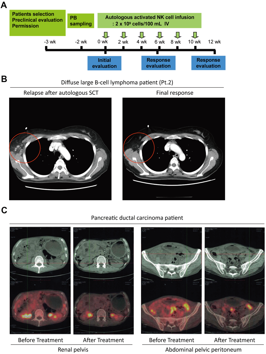 The potential anti-tumor activity of NKM cells. (A) The schedule of NKM-cell therapy for cancer patients. After physical examination, 20–30 ×108 NKM cells were used for each injection, and six injections were administered in one course of treatment, with a time interval of 2 weeks. (B) A complete response from a DLBCL patient (Pt. #2) undergoing NKM-cell treatment. (C) A complete response from a pancreatic-cancer patient to NKM-cell treatment (six treatments, once every week). The number of metastatic foci in the renal pelvis and peritoneum of the abdominal pelvis was reduced significantly after NKM-cell treatment.