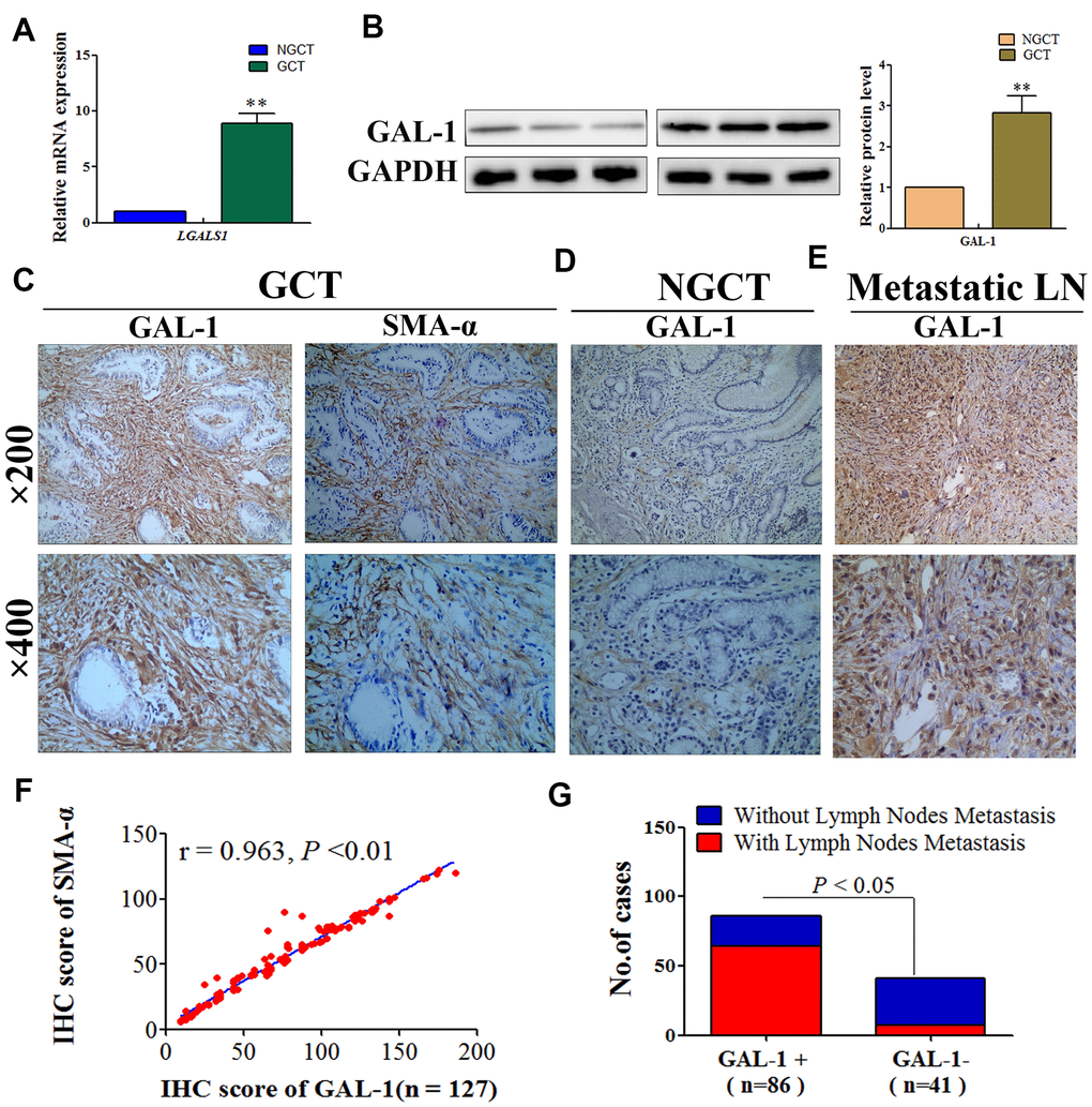 GAL-1/LGALS1 is overexpressed in CAFs and promotes lymph node metastasis in GC tissues. (A) GCT exhibited significantly higher levels of the LGALS1 mRNA than that in NGCT. (B) GAL-1 is overexpressed in GC tissues. (C–E) Representative images of IHC for GAL-1 and SMA-α protein levels in GCT, NGCT, and metastatic LN. (F) The IHC score of GAL-1 correlated positively with the IHC score of SMA-α in GC tissues (r = 0.963; P G) The lymph node metastasis rate of the GAL-1-positive group was significantly higher than that in the GAL-1-negative group (P 