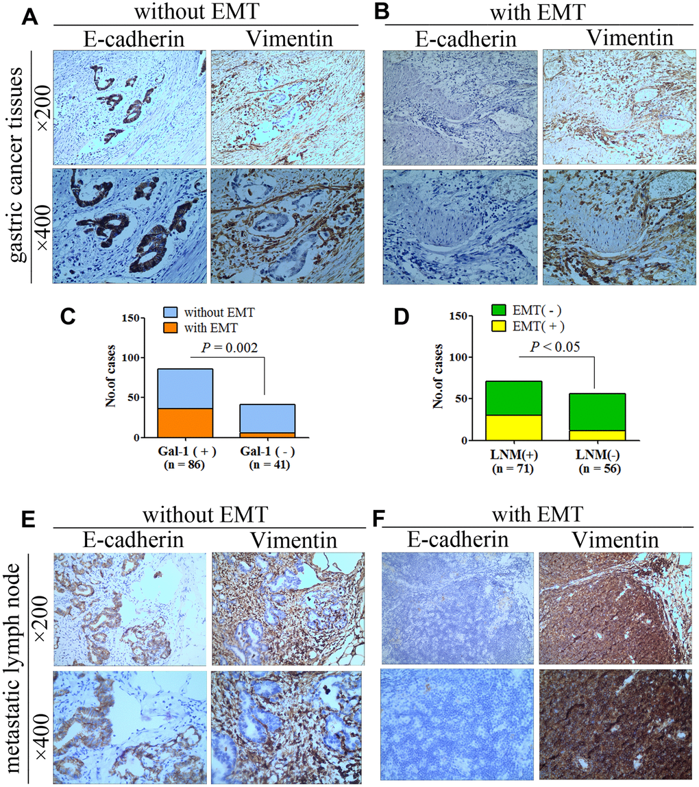 GAL-1/LGALS1 promotes EMT in GC, and EMT promotes lymph node metastasis of GC. (A) Representative images of GCT without EMT. (B) Representative images of GCT with EMT. (C) GAL-1/LGALS1 significantly promoted EMT in GC (P D) GC with EMT was more prone to lymph node metastasis (P E, F) Representative images of GC cells with or without EMT in metastatic lymph nodes.