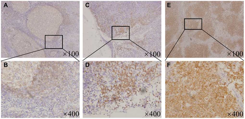 BTK expression in the MCL patients and the benign lymphoid tissues. (A) ×100 magnification and (B) ×400 magnification, Representative patterns of BTK expressing limitedly in the germinal center cells of the mantle zone in the tonsils. (C) ×100 magnification and (D) ×400 magnification, Representative patterns of low BTK expression with less than one-quarter positive staining proportion in the MCL patient tissues. (E) ×100 magnification and (F) ×400 magnification, Representative patterns of high BTK expression with widely broken and disappeared germinal center in the MCL patient tissues.