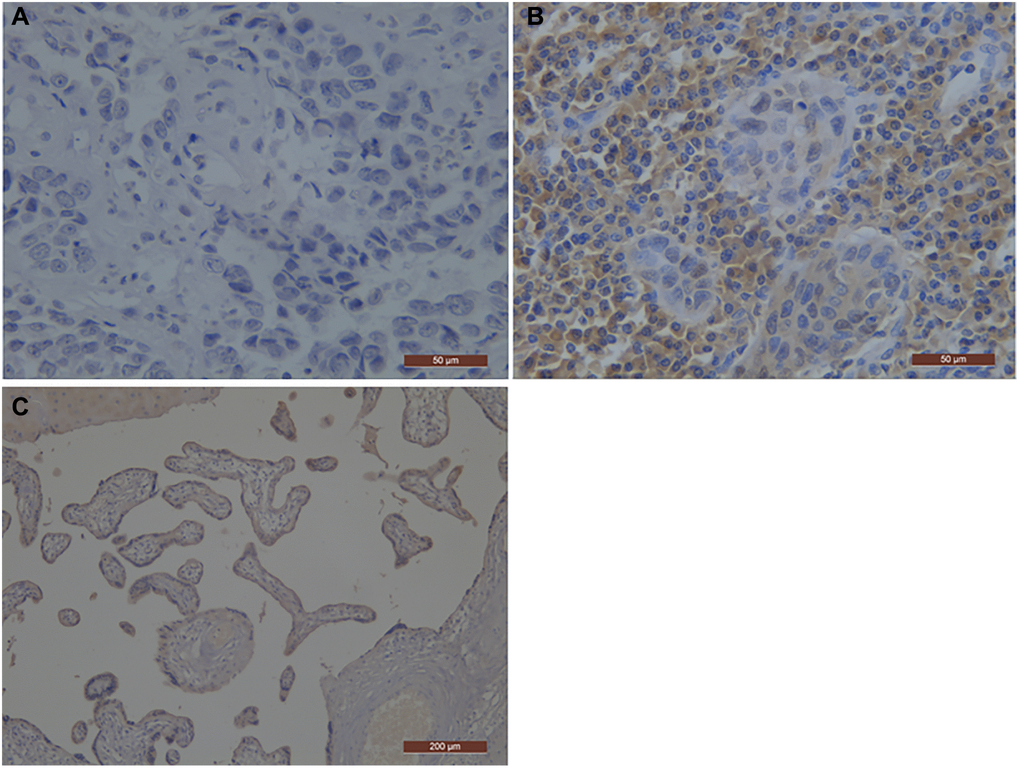 Representative photographs of PD-L1 immunostaining in esophageal squamous cell carcinoma. The positive staining was assessed against the positive control staining (Placental tissue). (A) Negative immunohistochemical staining pattern for PD-L1; (B) Positive immunohistochemical staining pattern for PD-L1; (C) the positive control staining (Placental tissue); PD-L1, programmed death-ligand 1.