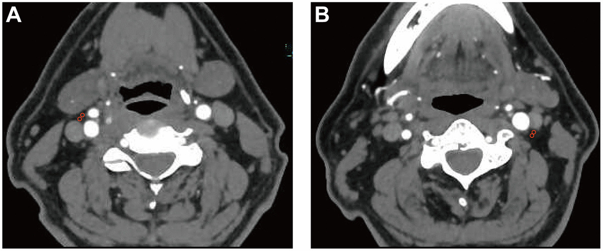 Association between carotid artery perivascular fat density and cerebral small vessel disease