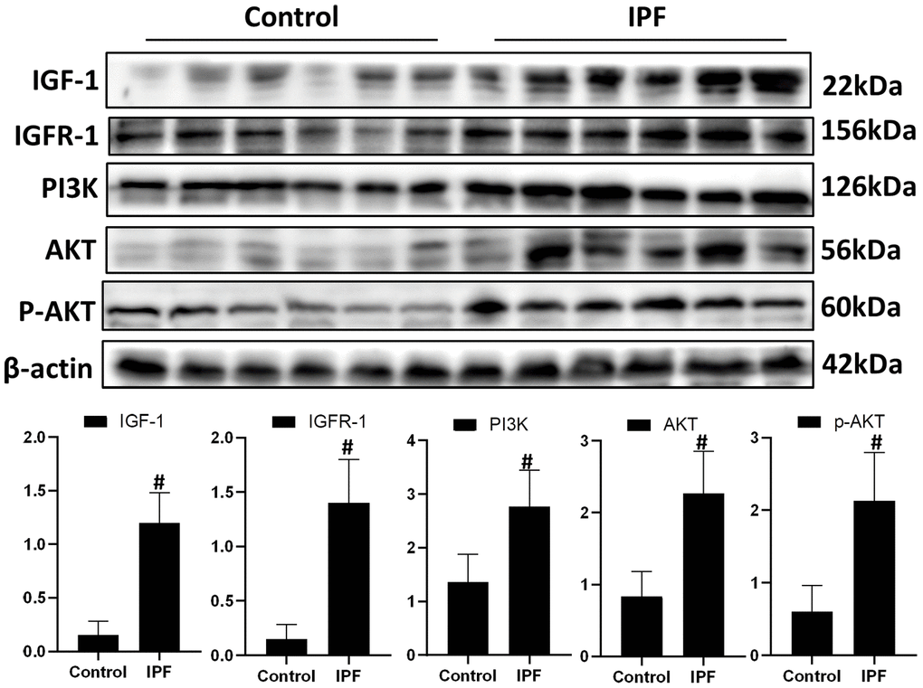 Activated IGF1 pathway in lung tissue from patients with IPF. IGF-1, IGFR-1, PI3K, AKT and p-AKT were assessed using western blotting analyses. #P 