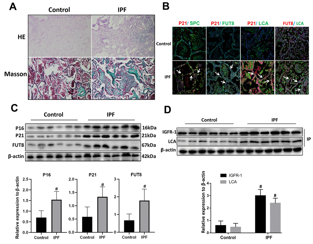 CF was increased in AECs of lung tissue from patients with IPF. (A) Representative results of HE staining and Masson staining in normal lung and lungs of patients with IPF (original magnification, 200×). (B) Representative images of dual staining for SPC (green) and P21 (red), FUT8 (green) and P21 (red), LCA (green) and P21 (red), and LCA (green) and FUT8 (red) (original magnification, 200×). (C) Western blotting was applied to detect the levels of activated P21, P16, and FUT8. (D) Lectin blot analysis of the immunoprecipitated IGFR-1 protein. IGFR-1 was immunoprecipitated from whole cell lysates using anti-IGFR-1 antibodies. The blots were probed with LCA. Representative data are shown. Quantification is shown in the lower panel. #P 