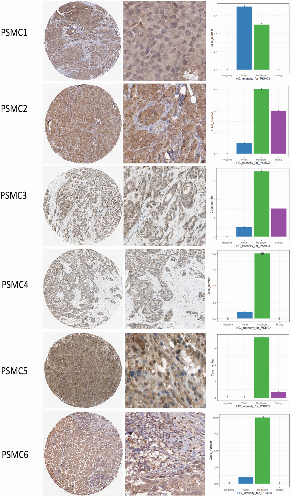 Protein expression levels of proteasome 26S subunit, ATPase (PSMC) family members across clinical specimens of breast cancer. PSMC1, PSMC4, and PSMC6 proteins were moderately expressed, and some clinical tissues showed strong PSMC2, PSMC3, and PSMC5 protein expressions in breast cancer.