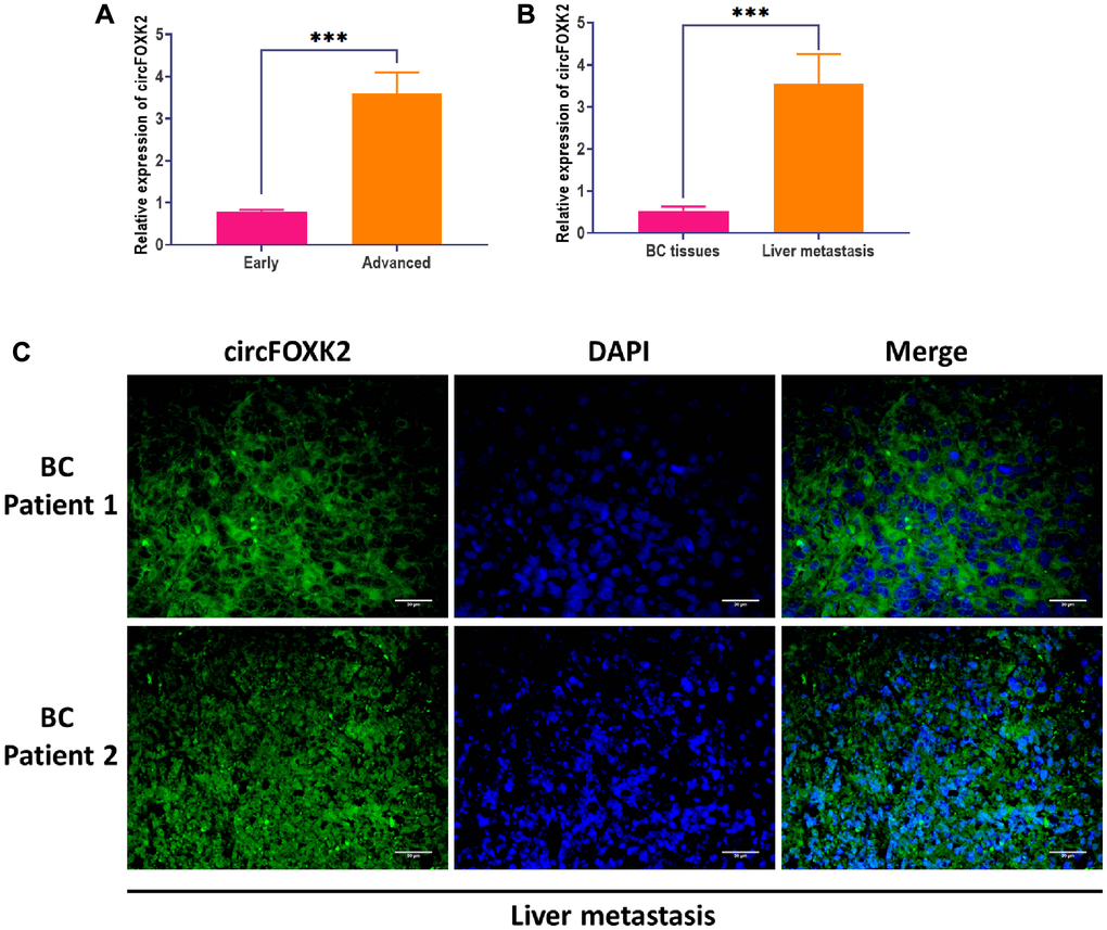 CircFOXK2 is involved in the metastasis of BC. (A) Expression of circFOXK2 in BC tissues in the early or advanced stage. (B) Expression of circFOXK2 in BC tissues or paired liver metastasis. (C) Expression of circFOXK2 in liver metastasis, as detected by RNA FISH assay. Scale bar: 30 μm. Data were represented as mean ± SD. Each experimental group had at least three replicates. *p **p ***p 