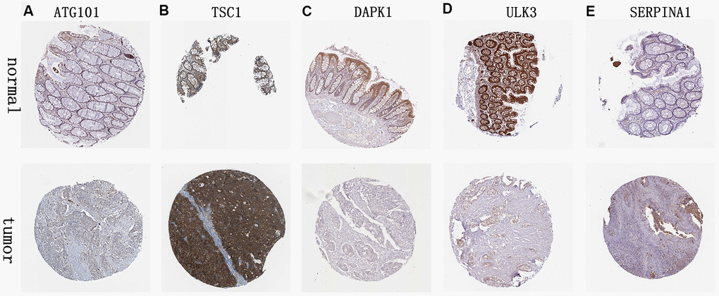 Validation of hub ARG expression in colon cancer and normal tissue. (A) ATG101, (B) TSC1, (C) DAPK1, (D) ULK3, and (E) SERPINA1.
