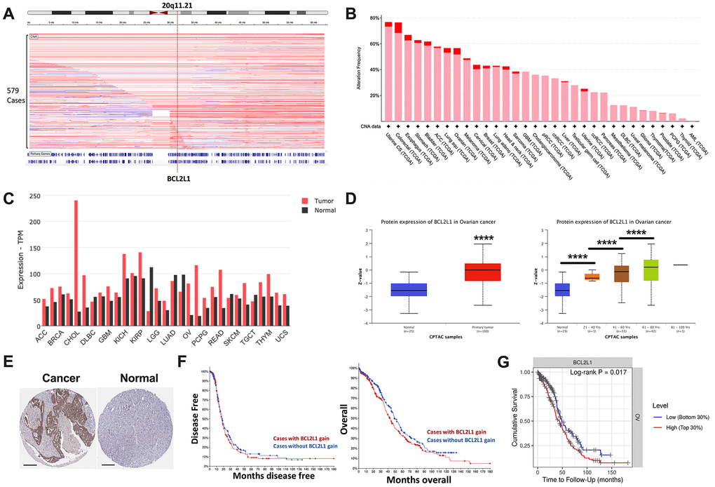 BCL2L1 is frequently gained in OvCa. Reproduced from TCGA OvCa dataset, shown were (A) copy number alteration of Cytoband 20q11.21 that encompassed BCL2L1; (B) frequency of gain (pink) and amplification (red) of BCL2L1 across all cancers in TCGA dataset; (C) differential expression of BCL2L1 across TCGA cancers; (D) Reproduced from CPTAC dataset, shown were protein level of BCL2L1 in different clinicopathological parameters; (E) representative IHC images of BCL2L1 in normal ovary tissue and ovarian cancer tissue; (F) overall and progression-free survival of OvCa cases with or without BCL2L1 gain/amplification in TCGA cohort; (G) overall survival of OvCa cases with top 30% or bottom 30% of BCL2L1 expression in TCGA cohort (*P 