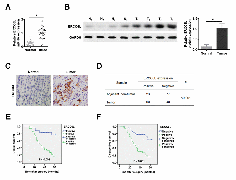 ERCC6L expression in GC tissues. (A) qRT-PCR detection of ERCC6L mRNA expression in GC tissues and adjacent normal tissues. (B) Western blot analysis of ERCC6L protein expression in tumor tissues (T) and matched normal tissues (N). (C) IHC analysis of ERCC6L expression in GC tissues and matched normal tissues. (D) Chi-square analysis of ERCC6L expression in GC tissues and adjacent non-tumor tissues based on IHC staining scores. (E) Kaplan-Meier analysis of overall survival for GC patients with different levels of ERCC6L expression. (F) Kaplan-Meier analysis of disease-free survival for GC patients with different levels of ERCC6L expression. *P 