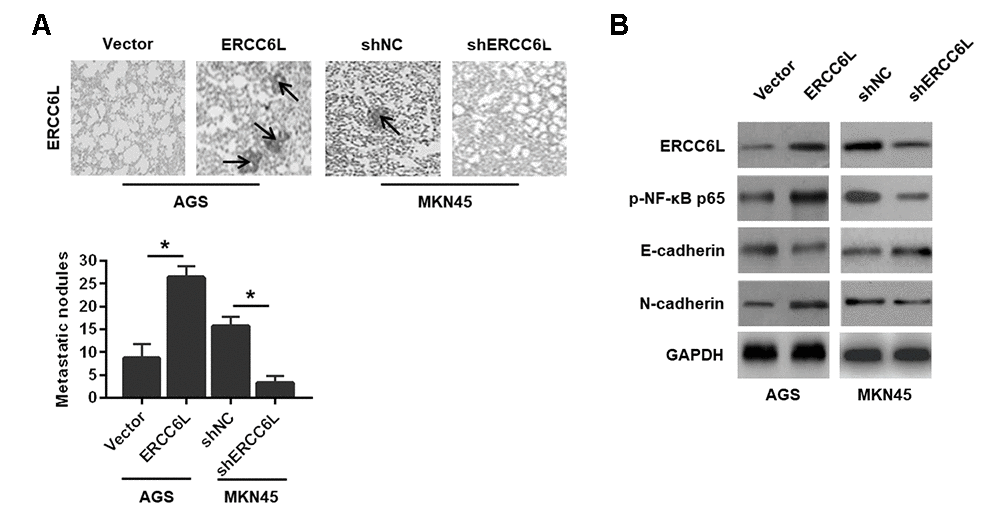 The effects of ERCC6L overexpression or knockdown on GC cells metastasis in vivo. (A) Representative images of the numbers of metastatic foci in lung of individual mouse. (B) Western blot analysis of the levels of ERCC6L, p-NF-κB p65, E-cadherin and N-cadherin in lung metastatic nodules. (n = 6, each group). *P 