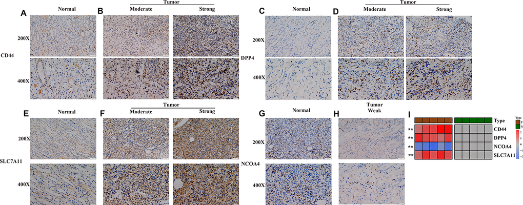 Experimental verification of four genes in the prognostic signature. (A–H) Immunohistochemical images of expression of the four proteins from the prognostic signature in non-tumor tissue samples (A, C, E, G) and tumor samples (B, D, F, H). (I) mRNA expression levels of 4 ferroptosis-related genes were evaluated using qRT–PCR in ccRCC samples and normal samples. *, P P P 