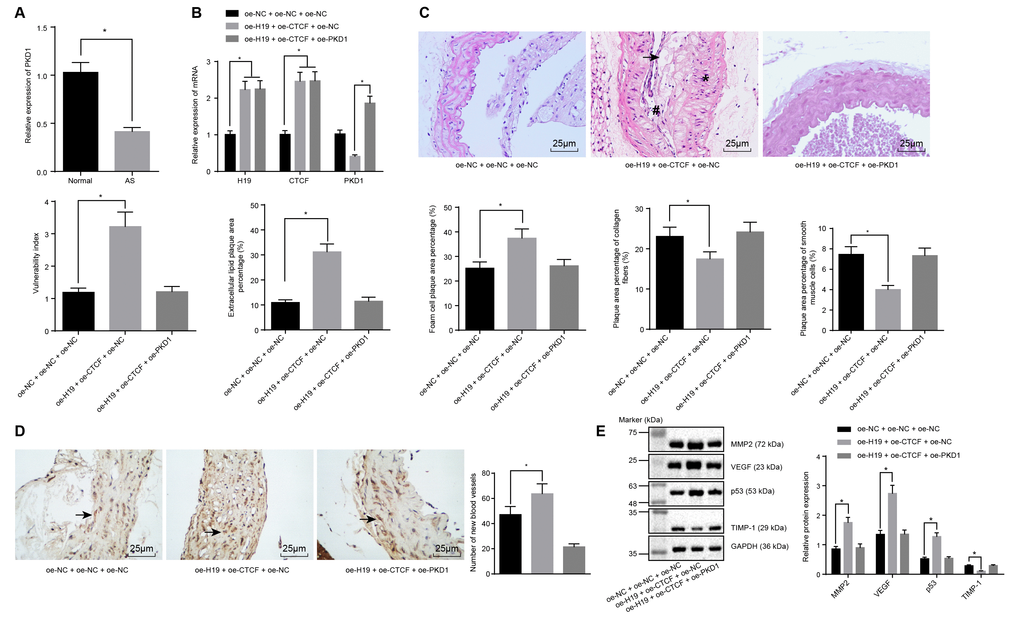 H19 is involved in atherosclerotic vulnerable plaque formation and intraplaque angiogenesis through down-regulating PKD1 by recruiting CTCF in ApoE knockout mice with AS. (A) The expression pattern of PKD1 in the aortic tissues of normal and AS mice determined by RT-qPCR. * p vs. the control group. (B) The overexpressing efficiency of H19, CTCF and PKD1 assessed by RT-qPCR. * p vs. the oe-NC + oe-NC + oe-NC group; # p vs. the oe-H19 + oe-CTCF + oe-NC group. (C) The atherosclerotic vulnerable plaque formation evaluated by HE staining (× 400) (The arrow referred to lipid vacuoles, * represented inflammatory cells and # indicated fractured smooth muscle). (D) The number of new blood vessels measured by Immunohistochemical staining (× 400) (The arrow referred to CD34-positive cells). (E) The protein levels of MMP-2, VEGF, p53 and TIMP-1 in atherosclerotic plaques normalized to GAPDH after transfection determined by Western blot analysis. * p vs. the oe-NC + oe-NC + oe-NC group. The data were measurement data and expressed by mean ± standard deviation. Data differences between two groups were analyzed by unpaired t-test; comparisons made among multiple groups were analyzed by one-way ANOVA. The experiments were repeated three times independently.