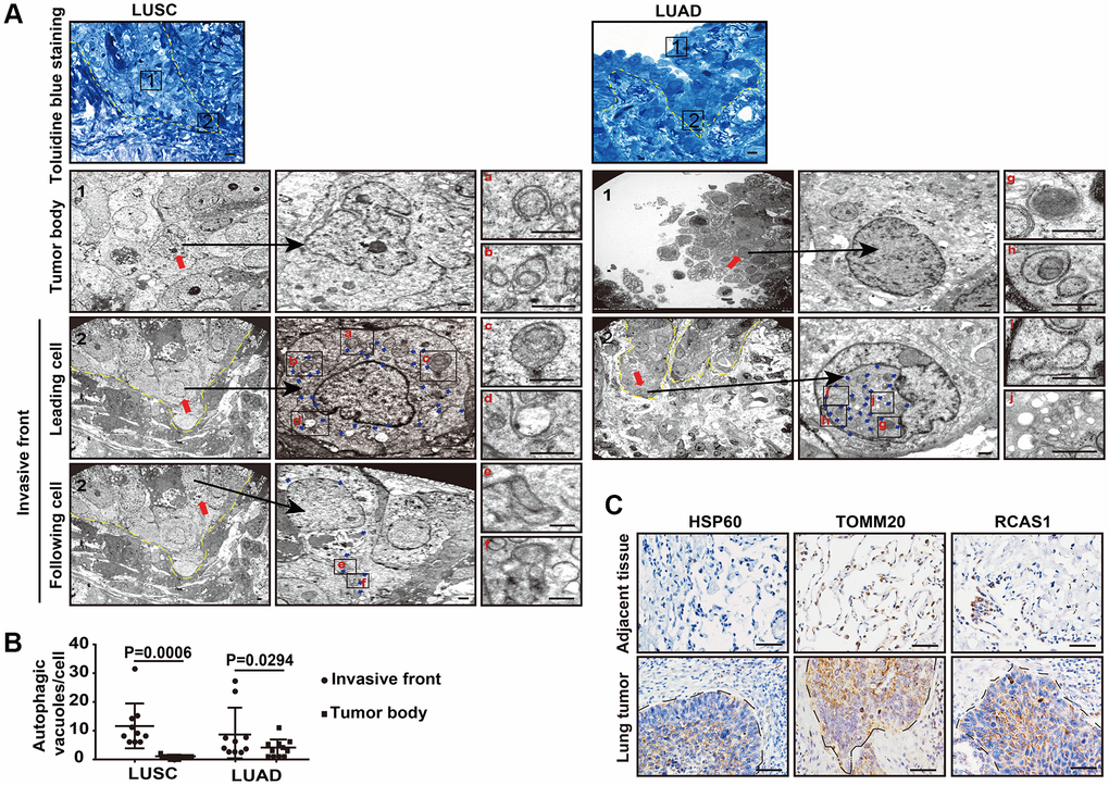 The autophagic flux is increased at the tumor invasive front. (A) Toluidine blue staining of the LUSC and LUAD for TEM (left panel). The TEM images show the autophagic vacuoles (blue arrows) in tumor cells located at the invasive front and inside the tumor body of LUSC and LUAD (right panel). Dashed line, tumor-stroma border. Red arrows, leader cells and following cells in invasive front and cells inside the tumor body. The enlarged images show autophagic vacuoles, including phagophores (a and g), autophagosomes (b and h), amphisomes (c, e, f and i) and autolysosomes (d and j). Scale bars, 50 μm for toluidine blue staining and 1 μm for TEM. (B) The quantification of the autophagic vacuoles per cell located at the tumor invasive front and inside the tumor body (P = 0.0006 in LUSC, P = 0.0294 in LUAD). Error bars, means ± SEM for 10 cells in a representative experiment. (C) Representative immunohistochemistry (IHC) images of HSP60, TOMM20 and RSCA1 in LUSC specimens and tumor-adjacent tissues. Scale bars, 50 μm.
