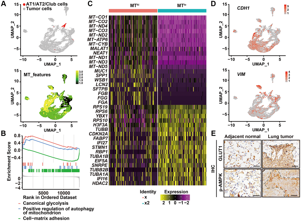 High autophagic cancer cells exhibited low MT-gene signature. (A) After removing the immune, endothelial and fibroblast cells, and re-clustering the remaining cells, predicted normal epithelial cell types, including AT1 (alveolar type I) cells, AT2 (alveolar type II) cells and club cells, based on gene expression were labeled (upper panel), and visualization of MT-gene signature scores (MT-ATP8, MT-ATP6, MT-CO1, MT-CO2, MT-CO3, MY-CYB, MT-ND1, MT-ND2, MT-ND3, MT-ND4, MT-ND4L, MT-ND5, MT-ND6) of malignant cells in 6 primary LUADs (lower panel). (B) GSEA analysis was performed to further screen the significant pathway between MTlo and MThi cancer cells. (C) Heatmap showing the expression level of the top 20 differentially expressed genes for MTlo and MThi clusters. (D) UMAP visualization of CDH1 and VIM of malignant cells in 6 primary LUADs. (E) IHC staining of phosphorylated AMPK (p-AMPK) and GLUT1 in tumor-adjacent tissue and LUSC tissue. Dashed line, tumor-stroma border. Scale bars, 50 μm.