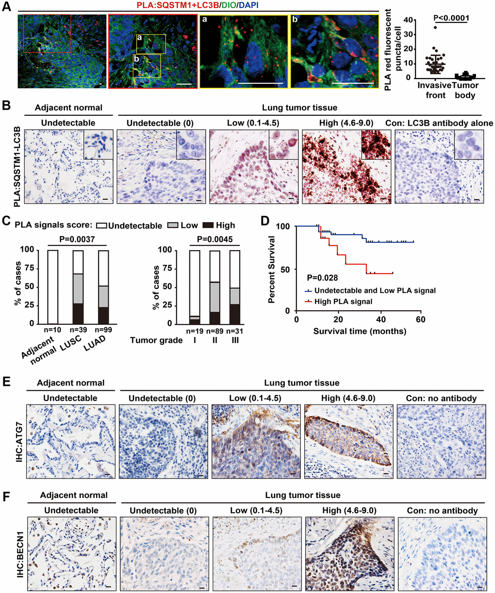 Increased SQSTM1-LC3B interaction at the tumor invasive front is correlated with poor outcome in NSCLC patients. (A) Endogenous physical interactions between SQSTM1 and LC3B in LUSC sections were detected by in situ PLA (indicated by red fluorescent puncta) and visualized by laser scan confocal microscopy. Membrane structures were counterstained with a DIO probe (green). The enlarged regions show positive PLA signals of SQSTM1-LC3B protein complexes at the tumor invasive front (a-b). Scale bars, 50 μm. The scatter diagram of the PLA results shows the number of red fluorescent puncta per cell at the tumor invasive front and inside the tumor body (P B) Representative images of in situ bright-field PLA of SQSTM1-LC3B protein complexes in NSCLC specimens and tumor-adjacent tissues, counterstained by Hematoxylin. Scale bars, 50 μm. (C) in situ PLA of SQSTM1-LC3B protein interaction was performed on tumor-adjacent lung tissues (n = 10), LUSC (n = 39), and LUAD (n = 99) specimens. The frequency of patient with undetectable (0), low (P = 0.003) (left panel) or by NSCLC grade (ANOVA, P = 0.0045) (right panel). (D) Survival rates in 64 of the 148 NSCLC patients determined by Kaplan-Meier analysis were compared between patients with undetectable and low (PLA signals score ≤ 4.5, n = 48, blue line) and high (PLA signals score > 4.6, n = 16, red line) PLA signal scores for the SQSTM1-LC3B interaction. Three-year survival rates were 85% (undetectable and low PLA signal scores of SQSTM1-LC3B interaction) versus 33% (high PLA signal scores of SQSTM1-LC3B interaction; P = 0.028). (E and F), Representative IHC images of ATG7 and BECN1 in NSCLC specimens and tumor-adjacent tissues. Scale bars, 50 μm.