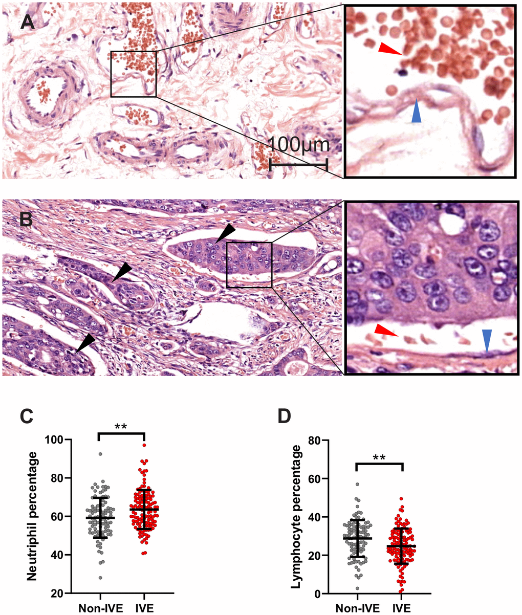 IVE related to peripheral lymphocyte and neutrophil percentage. (A, B) representative H&E staining images of cancer tissue without IVE (A) and with IVE (B). IVE is indicated by black arrows, the wall of vessels and red cells are indicated by blue arrows and red arrows, respectively. (C, D) IVE patients had higher neutrophil percentage (C) and lower lymphocyte percentage (D) relative to non-IVE patients. (**, P 