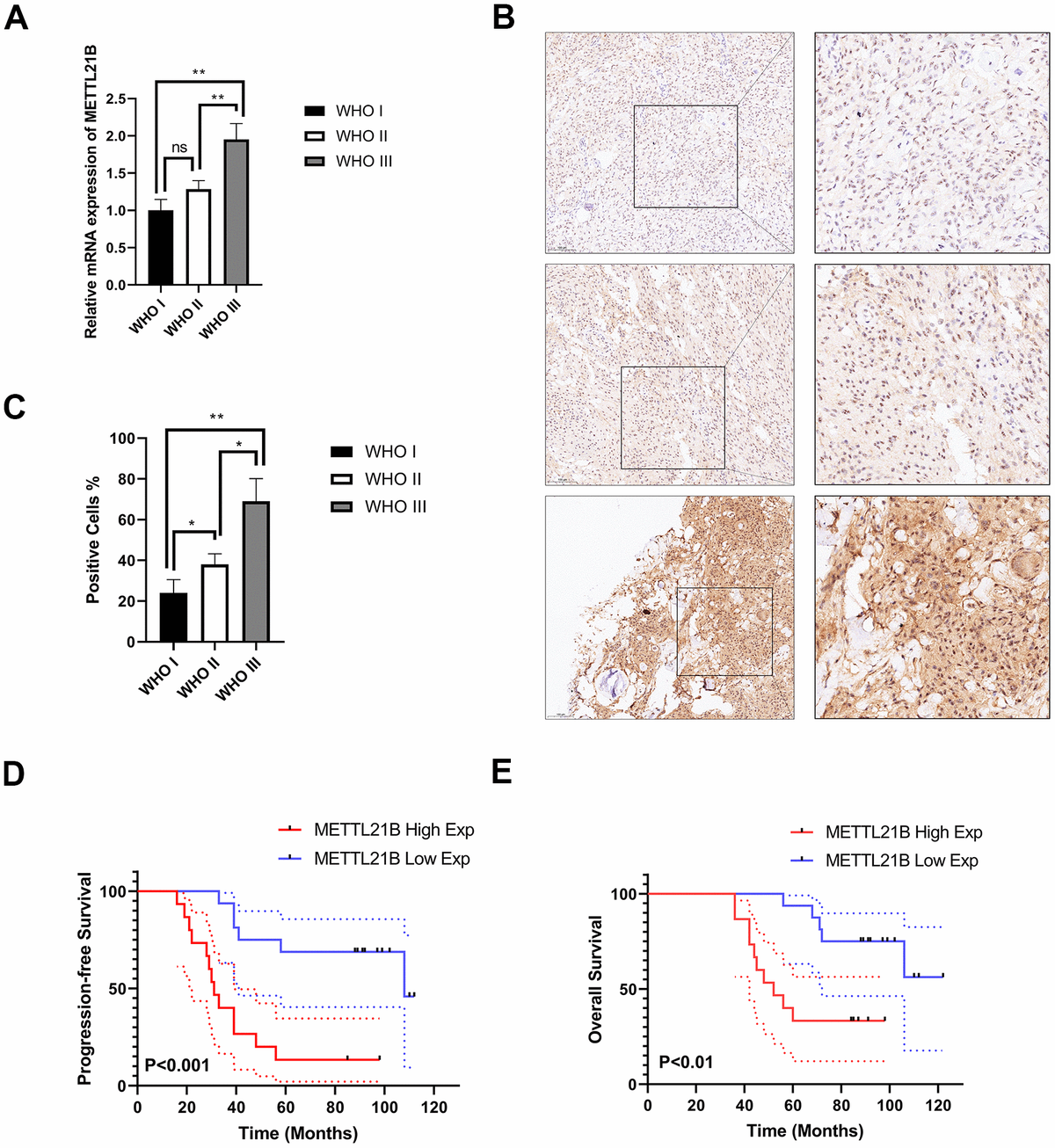 Experimental examination of METTL21B expression and prognosis analysis in LGG patient clinical samples. (A) The relative mRNA expression level in LGG with different WHO grades. (B) Representative immunohistochemistry images for METTL21B in LGG with different WHO grades. Positive cells showed nuclear and/or cytoplasmic brown staining while negative cells showed blue nuclei counter staining. (C) METTL21B positive cells were counted in LGG with different WHO grades. *PD, E) METTL21B high expression predicts a worse progression-free and overall survival (P
