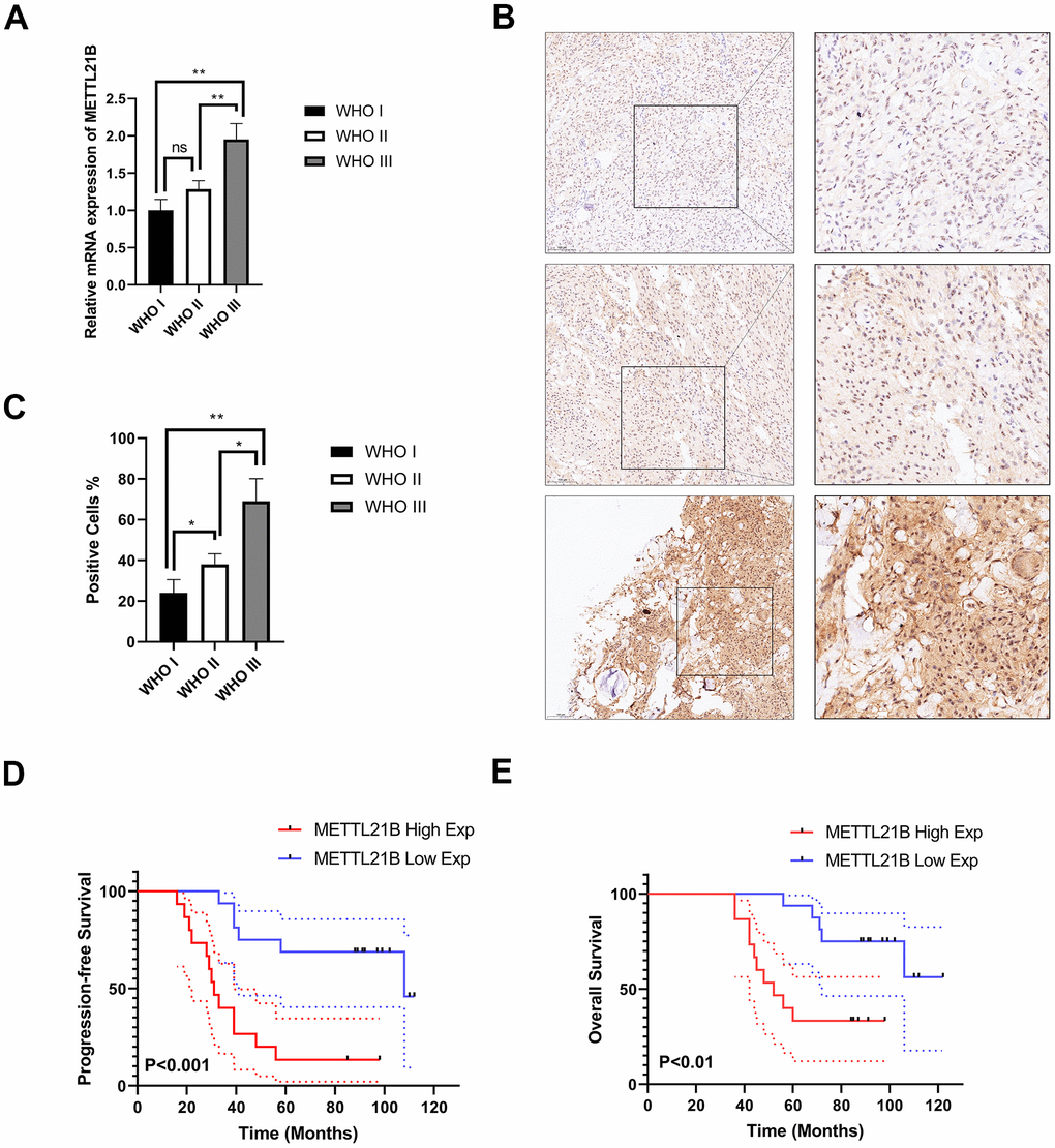Experimental examination of METTL21B expression and prognosis analysis in LGG patient clinical samples. (A) The relative mRNA expression level in LGG with different WHO grades. (B) Representative immunohistochemistry images for METTL21B in LGG with different WHO grades. Positive cells showed nuclear and/or cytoplasmic brown staining while negative cells showed blue nuclei counter staining. (C) METTL21B positive cells were counted in LGG with different WHO grades. *PD, E) METTL21B high expression predicts a worse progression-free and overall survival (P