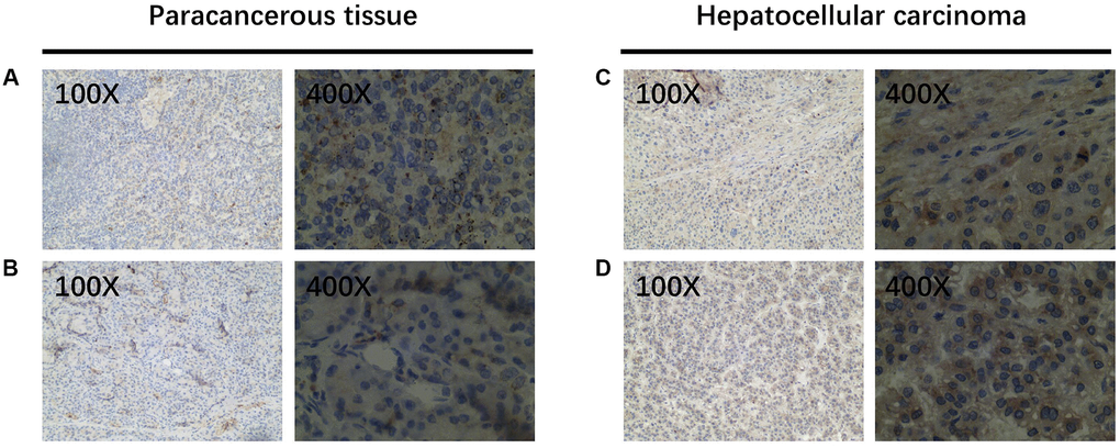WIP1 expression in paracancerous and hepatocellular carcinoma tissues. (A, B) Wip1 is low expressed in paracancerous tissues; (C, D) Wip1 is highly expressed in tumor tissues.