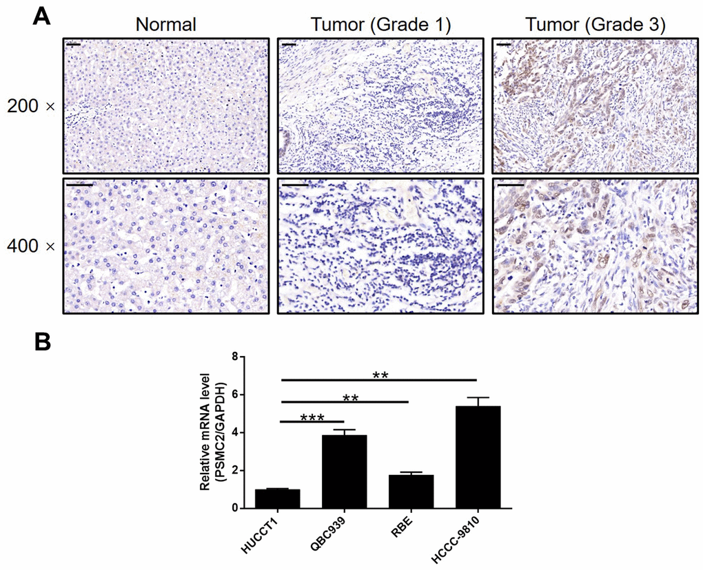 PSMC2 was upregulated in CCA tissues and abundantly expressed in CCA cells. (A) The expression level of PSMC2 was detected by IHC analysis in CCA tissues and normal tissues (scale bar = 50 μm). (B) The endogenous expression of PSMC2 in CCA cell lines including HUCCT1, QBC939, RBE and HCCC-9810 was evaluated by qPCR. Data was shown as mean ± SD. *P P P 