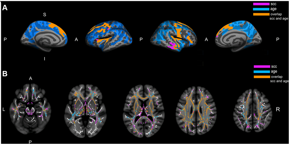 Association of subjective cognitive complaints and age with cortical thickness and white matter integrity. (A) Represents the cortical thinning exclusively associated with subjective cognitive complaints (pink), the cortical thinning exclusively associated with age (blue), and the cortical thinning associated with both complaints and age (orange). (B) Represents the increase in mean diffusivity exclusively associated with subjective cognitive complaints (pink), the increase in mean diffusivity exclusively associated with age (blue), and the increase in mean diffusivity associated with both complaints and age (orange); The white matter skeleton is represented in white color. All the represented clusters are statistically significant at p>0.01 after correction for multiple testing; A: anterior; P: posterior; S: superior; I: inferior; L: left; R: right; SCC: subjective cognitive complaints.