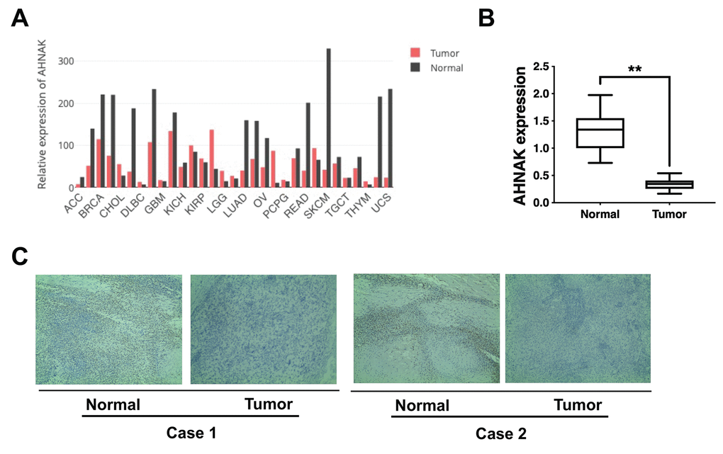 AHNAK is downregulated in ovarian cancer. (A) AHNAK expression pattern across all tumor samples and matched non-malignant samples. (B) AHNAK expression levels in 30 serous ovarian cancer tissues and paired non-malignant tissues. **p C) Images illustrating immunohistochemical staining of AHNAK content in two pairs of paired ovarian cancer samples and their neighboring non-malignant tissue. Original magnification, 200X.