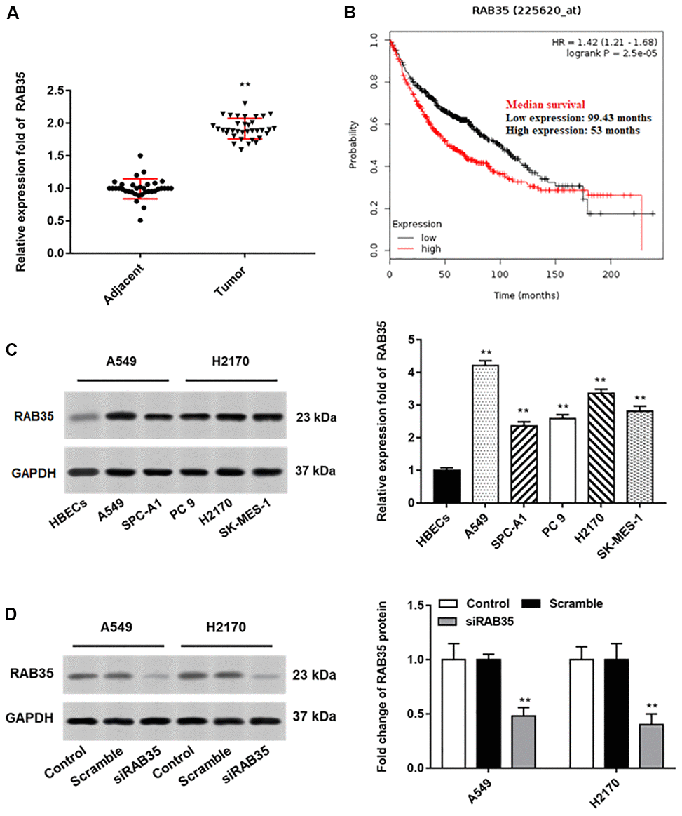 RAB35 is upregulated in NSCLC tissues and cell lines. The NSCLC tissues and tissues larger than 5 cm around the tumor were collected (N=70, 35 tumor tissues and 35 adjacent tissues). (A) RT-qPCR was used to detect the relative expression of RAB35 in tumor tissues and adjacent healthy tissues, and the results showed that RAB35 was upregulated in NSCLC tissues. (B) KM plotter software (http://kmplot.com/analysis/) was used to analyze the expression and survival of RAB35 gene in 1928 lung cancer patients. (C) Western blotting was used to detect the relative protein expression of RAB35 in NSCLC cell lines (A549, SPC-A1, PC 9, H2170 and SK-MES-1 cells) and normal bronchial epithelial cell line (HBECs), and the results showed that RAB35 was upregulated in NSCLC cell lines. (D) RAB35 siRNA and negative control (Scramble) were transfected into A549 cells and H2170 cells, respectively. The protein expression of RAB35 was analyzed by Western botting. β-actin was used as an internal reference. N=6, ** P