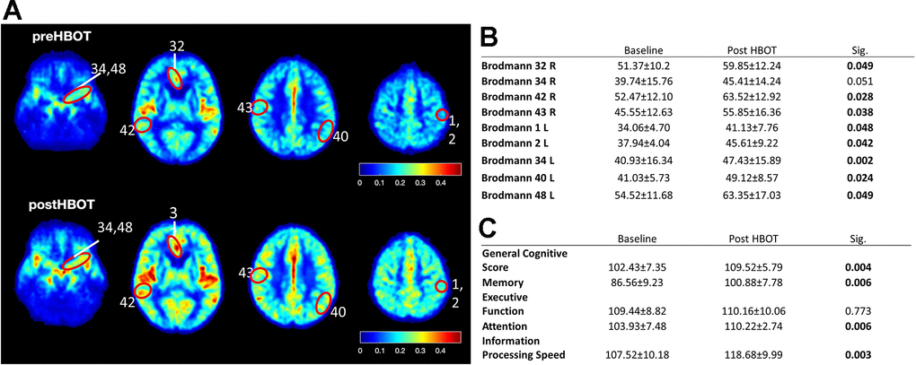CBF and cognitive function are improved following HBOT of patients. CBF and cognitive functions of six patients suffering from memory decline at baseline and following 60 HBOT sessions. (A) Average normalized CBF maps (DSC) at baseline and post-HBOT. (B) Significant average CBF changes in Brodmann areas at baseline and post-HBOT. (C) Average cognitive domain scores (Neurotrax) at baseline and post-HBOT.