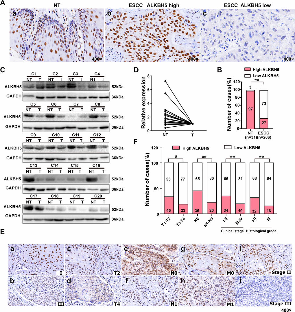 ALKBH5 was downregulated in ESCC tissue specimens, and its downregulation was associated with advanced TNM and clinical stages of ESCC. (A) Representative immunohistochemistry images showing ALKBH5 protein expression in adjacent non-tumor (NT) and ESCC tissue specimens. (a) High expression of ALKBH5 in adjacent non-tumor (NT) specimens. (b) High expression of ALKBH5 in ESCC specimens. (c) Low expression of ALKBH5 in ESCC specimens. The brown staining indicates ALKBH5 immunoreactivity. (B) IHC assay revealed lower ALKBH5 expression in ESCC tissue specimens than in the adjacent healthy tissues (P 2 test). (C) Western blots showing ALKBH5 protein expression in ESCC specimens and paired adjacent NT biopsies. (D) Western blotting revealed lower ALKBH5 expression in ESCC tissue specimens than in the adjacent healthy tissues. (E) Representative images of ALKBH5 expression in ESCC biopsies with different TNM and clinical stages. High expression of ALKBH5 was observed in clinical stages I (a), T2 (c), N0 (e), M0 (g) and histological grade II (i) of ESCC biopsies, whereas low expression of ALKBH5 was detected in clinical stages III (b), T4 (d), N1 (f), and M1 (h), and histological grade III (j). (F) Numbers and percentages of disease cases with high or low expression of ALKBH5 according to different clinicopathological features.