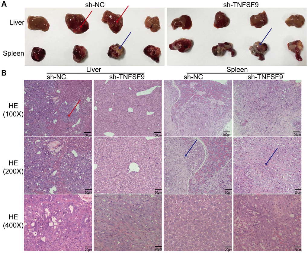 TNFSF9 promotes metastasis of pancreatic cancer in vivo. (A) Compared with the sh-TNFSF9 group, there were obvious metastases in the liver tissue of nude mice in the sh-NC group, and no normal spleen tissue was seen. (B) HE staining confirmed liver metastases of pancreatic cancer and splenic implants. The red arrow indicates metastasis of liver lesions. The blue arrow indicates the spleen implanted tumor.