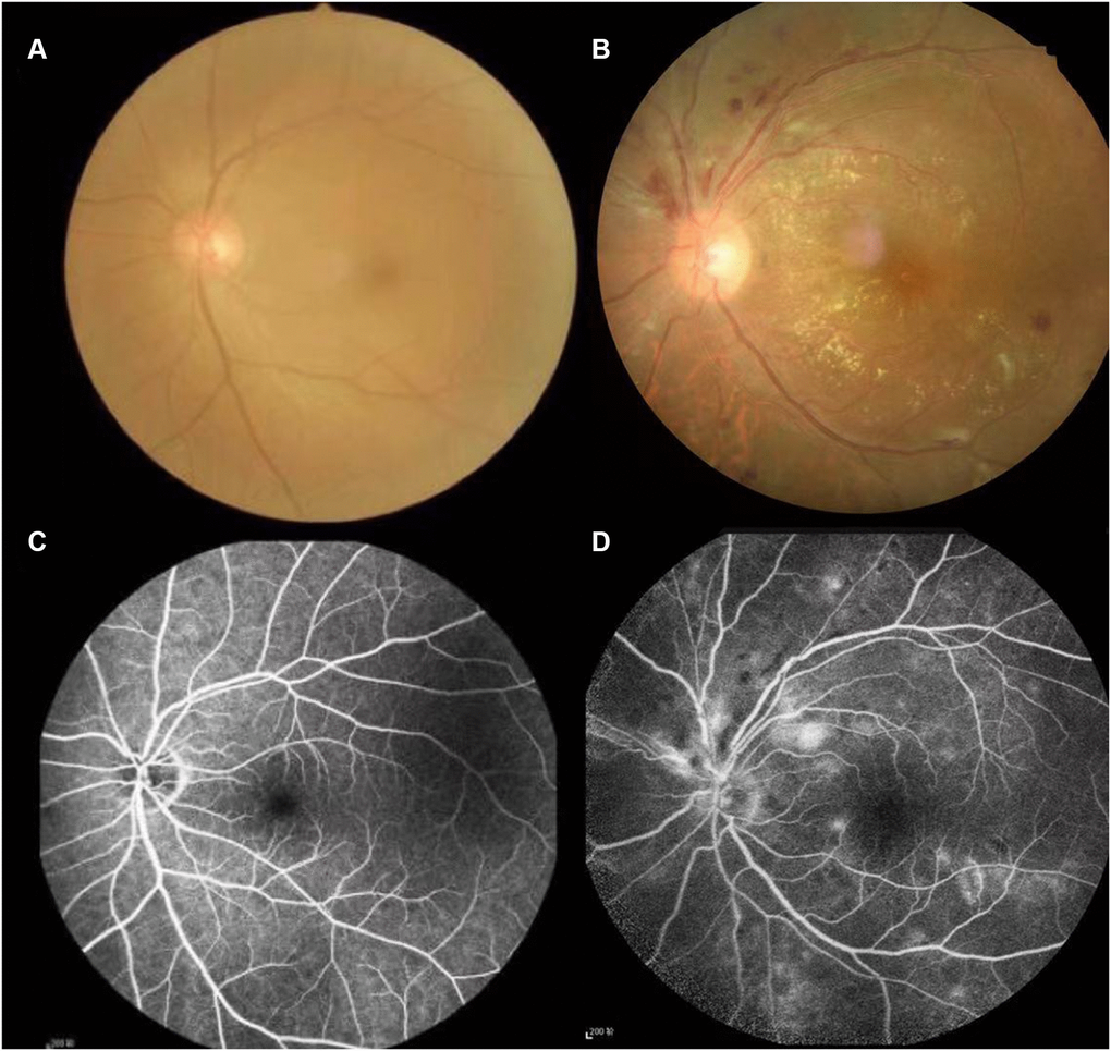 Typical examples of fundus camera and fluorescence fundus angiography in healthy people and patients with Hypertensive retinopathy. (A and C) of Figure 1 shows the left retinal fundus photos and corresponding fluorescence fundus angiography of healthy people. (B and D) of Figure 1 shows the left retinal fundus photos and fluorescence fundus angiography of patients with hypertensive retinopathy. Retinal arteriosclerosis, stenosis, wall light reflection enhancement, silver filiform, artery and vein cross compression phenomenon, the distal vein and capillary dilatation, retinal edema, bleeding and exudation.
