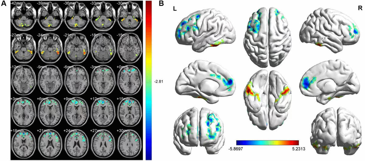 FMRI showed brain regions where the ALFF values' difference was statistically significant between the HR and HC groups. The difference of ALFF value is shown in (A, B) shows the ALFF changes in the cerebral cortex. Different is shown in the left medial SFG, left MFG, left ICL, vermis, left ITG and right SCL. The yellow and red areas represent an increase in ALFF values; the blue regions reduce ALFF values.
