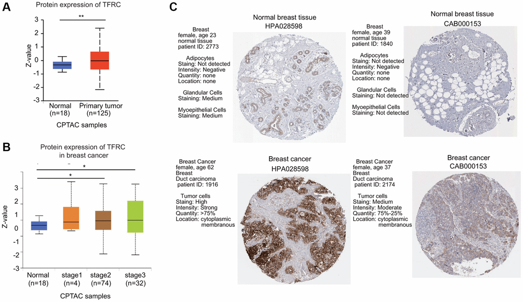 The protein expression level of TfR1 in BC. (A) TfR1 expression at the protein level in BC tissues (n = 125) and normal breast tissues (n = 18) through UALCAN database. (B) TfR1 protein expression was investigated in patients with different stages of BC (normal individuals, n = 18; stage 1, n = 4; stage 2, n = 74; and stage 3, n = 32). (C) The protein expressions of TfR1 were evaluated using the HPA database. The results of IHC staining suggested that the TfR1 protein was expressed at high levels in BC tissues. ***