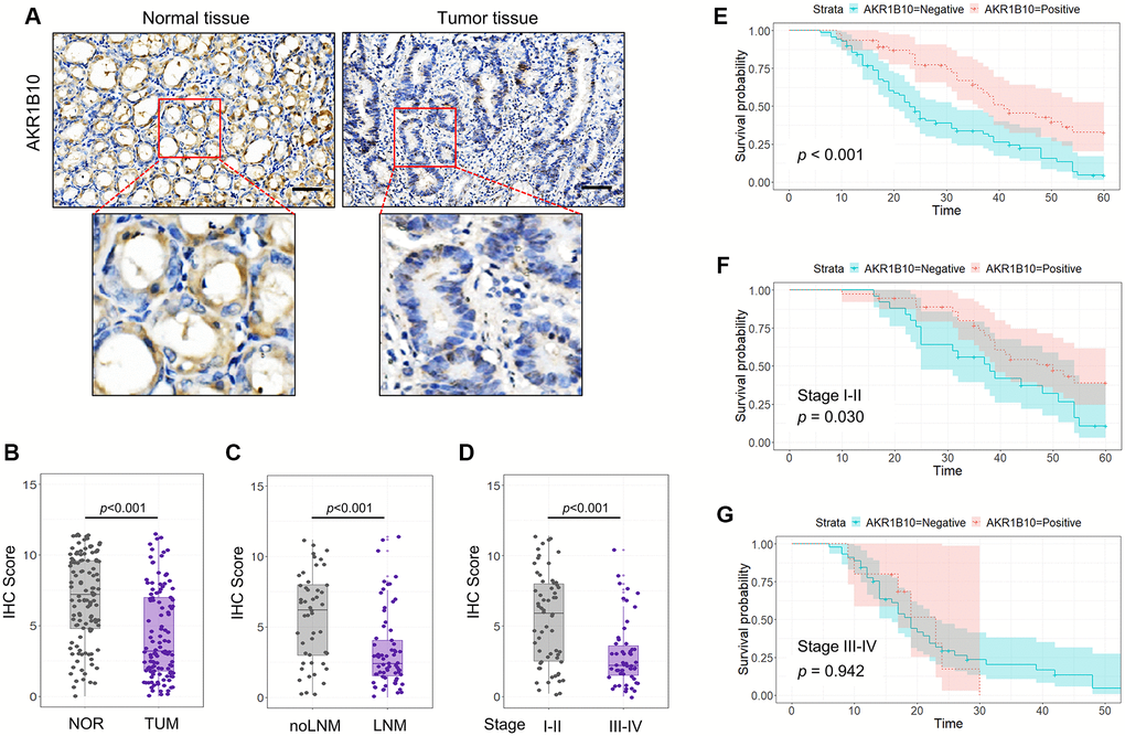 Expression of AKR1B10 in gastric cancer tissues. (A) Representative immunohistochemistry images showing in situ AKR1B10 expression in gastric cancer (GC) and normal tissues (scale bar = 100 μm). (B–D) IHC scores of AKR1B10 in (B) GC vs normal tissues, (C) tumors with and without lymph node invasion, and (D) TNM stage I–II vs III–IV. (E–G) overall survival analysis of (E) AKR1B10pos vs AKRiB10neg GC patients, and in subgroups overall survival analysis of TNM stage I–II (F) and III–IV (G). LNM, Lymph node metastasis.