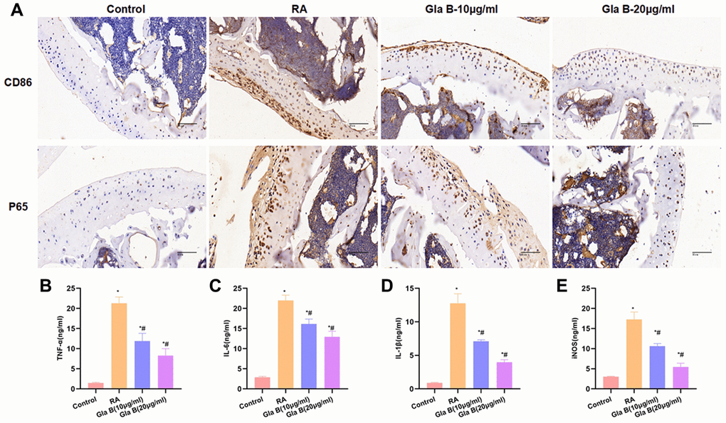 The effect of Gla B on the expression of M1 type cells and P65 in bone tissue. (A) Detection of CD86 and P65 revealed that the levels of CD86 and P65 were relatively low in Control group, without infiltration of M1 type cells. The expression of CD86 and P65 was significantly up-regulated in RA, with obvious M1 polarization. While Gla B could inhibit the expression of C86 and P65. (B–E) Detection of M1 type cell markers. The levels of TNF-α, IL-1β, IL-6 and iNOS were significantly higher in RA than those in Control group. Gla B could inhibit the expression of TNF-α, IL-1β, and IL-6 and iNOS, which was significantly decreased compared with RA. Comparison with Control, *P #P 