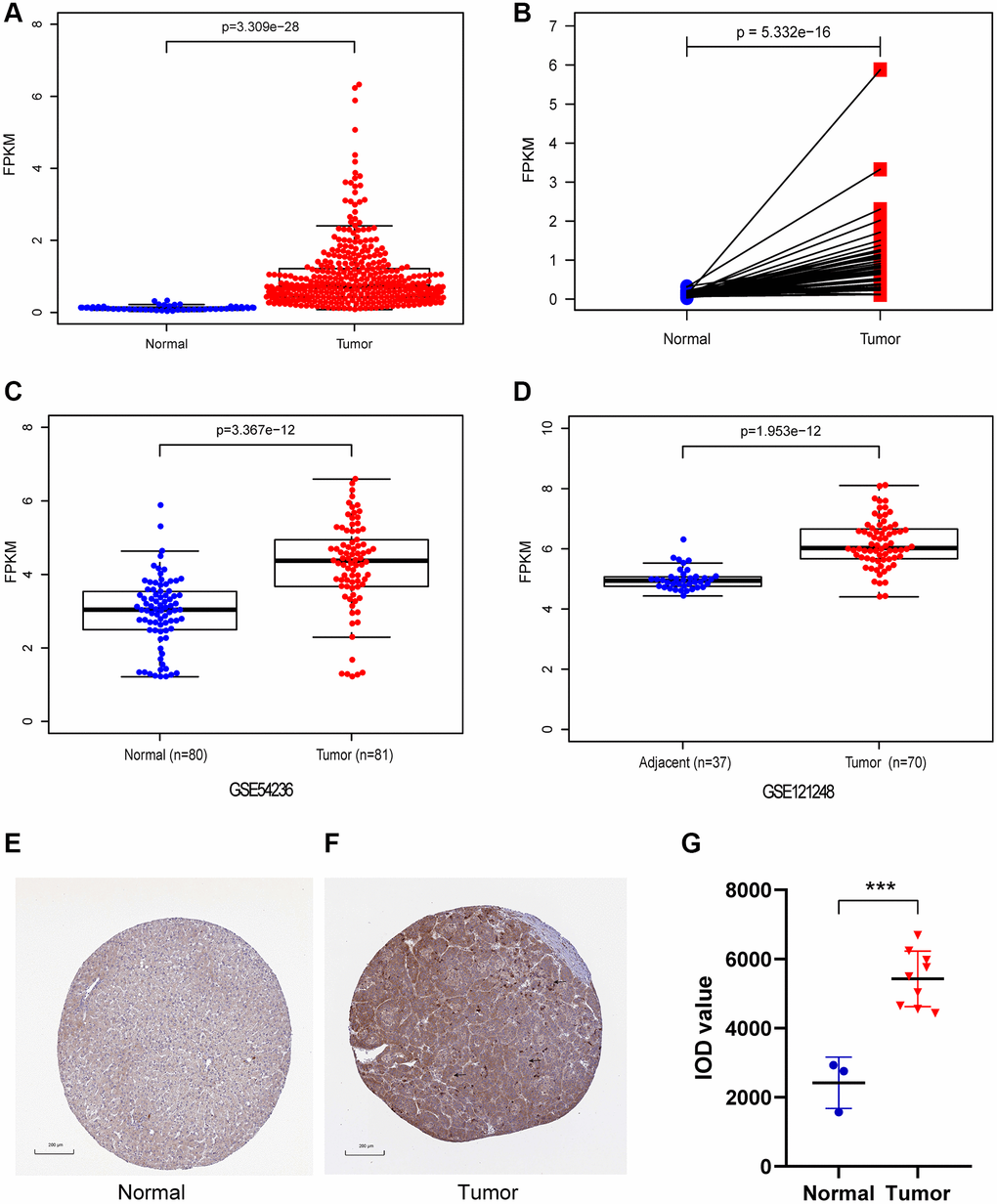 The mRNA and protein expression of CENPL in HCC. (A) CENPL showed significantly high expression in HCC tissues than in normal tissues using Wilcoxon rank sum test. (B) The expression of CENPL was prominently highly expressed in HCC tissues compared with adjoining non-cancerous tissues via Wilcoxon signed-rank test. (C and D) suggested CENPL was prominently enhanced in HCC samples from GSE121248 and GSE54236. (E–G) compared with the normal group, the protein level of CENPL in the liver cancer group was significantly increased. Abbreviation: CENP: centromere protein.