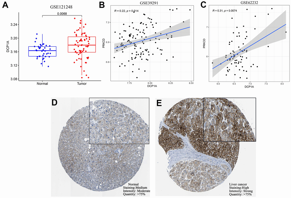 External verification of DCP1A expression and the relationship with the target gene, PRKCD. (A) Expression level of DCP1A was higher in HCC tissue compared with the level in normal tissue in the GSE121248 dataset. (B, C) DCP1A expression was positively correlated with the expression of the target gene, PRKCD in GSE39291 and GSE62232 datasets. (D, E) Expression of DCP1A was higher in HCC tissue compared with the level in normal tissue from HPA IHC dataset.