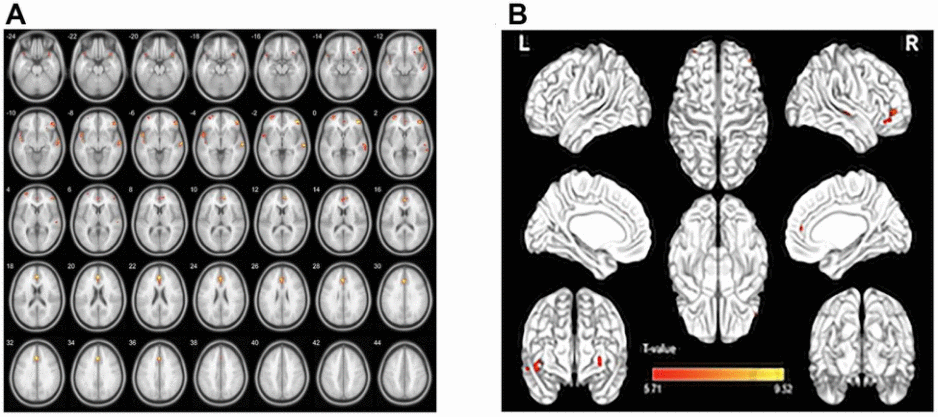 GMV regional decrease in patients with nAMD compared with HCs. (A, B). Notes: Compared with the HC group, the GMV was reduced in the right inferior frontal gyrus in the patients with nAMD, as well as left superior temporal gyrus temporal pole, left superior temporal gyrus, left middle frontal gyrus, left anterior cingulate and paracingulate gyrus. Abbreviations: nAMD, neovascular age-related macular degeneration; HC, healthy controls; GMV, gray matter volume.