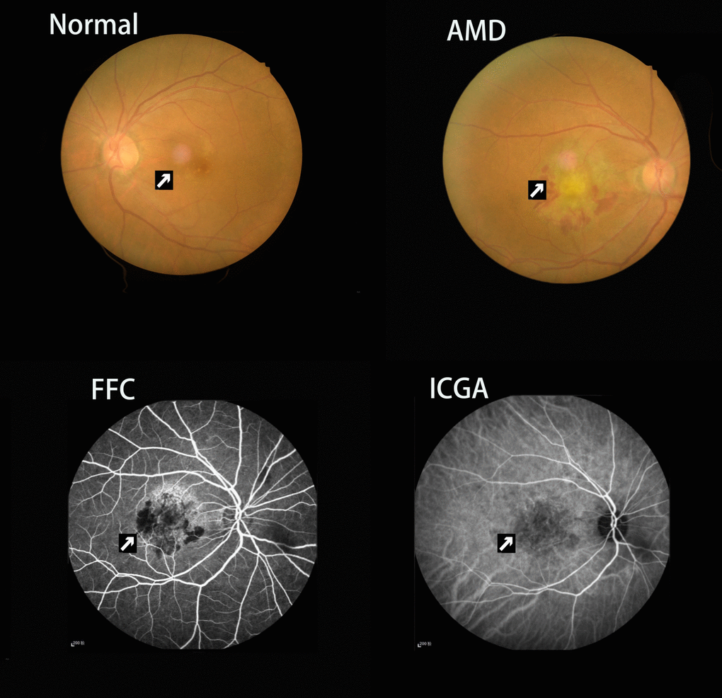 Example of choroidal neovascularization and macular scar caused by neovascular age-related macular degeneration seen on fundus camera and fluorescence fundus angiography. Abbreviations: FC, fundus camera; FFA, fluorescence fundus angiography; ICGA, indocyanine green angiography.