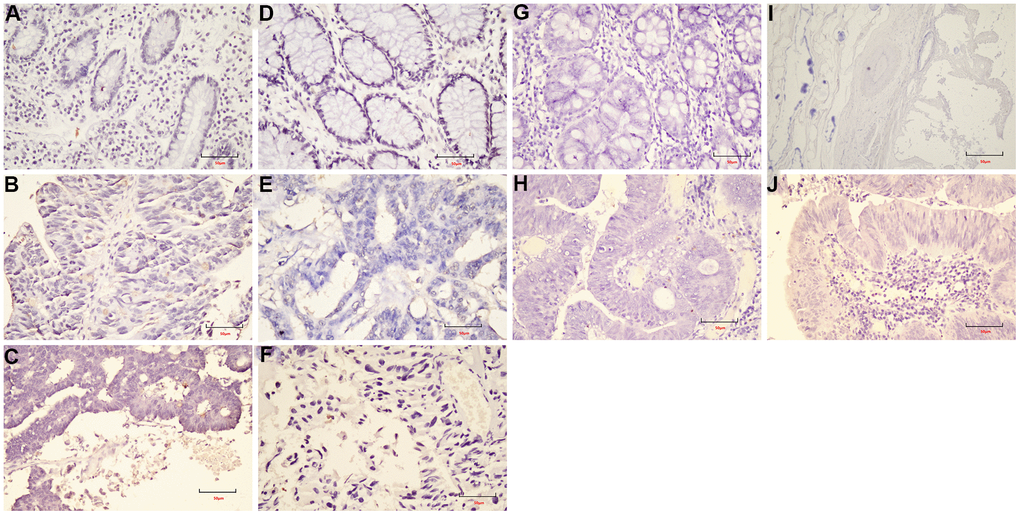 The expression of cyclin D1 in FFPE samples. (A) DST-LRRC; (B) DST-PRC; (C) DST-rectal tissue; (D) LZQ-LRRC; (E) LZQ-PRC; (F) LZQ-rectal tissue; (G) LHC-NRRC; (H) LHC-rectal tissue; (I) SCC-NRRC; (J) SCC-rectal tissue. Scale bar=50μm.