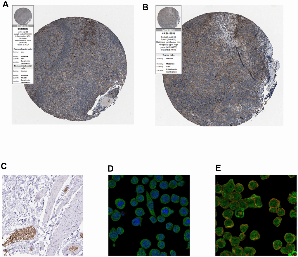 (A, B) Immunohistochemistry of CALR gene in normal and tumor tissues from HPA database. (A) Normal tissues (antibody: CAB019952; staining: low; intensity: moderate; quantity: B) Tumor samples (antibody: CAB019952; staining: medium; intensity: moderate; quantity: > 75%). (C) Immunohistochemical staining of human gallbladder shows positivity in erythrocytes, (original magnification: 20x). (D, E), Immunofluorescence of EPB42 gene in HEL cell lines (myeloid tissues, antibody: HPA040261) (original magnification: 400x).