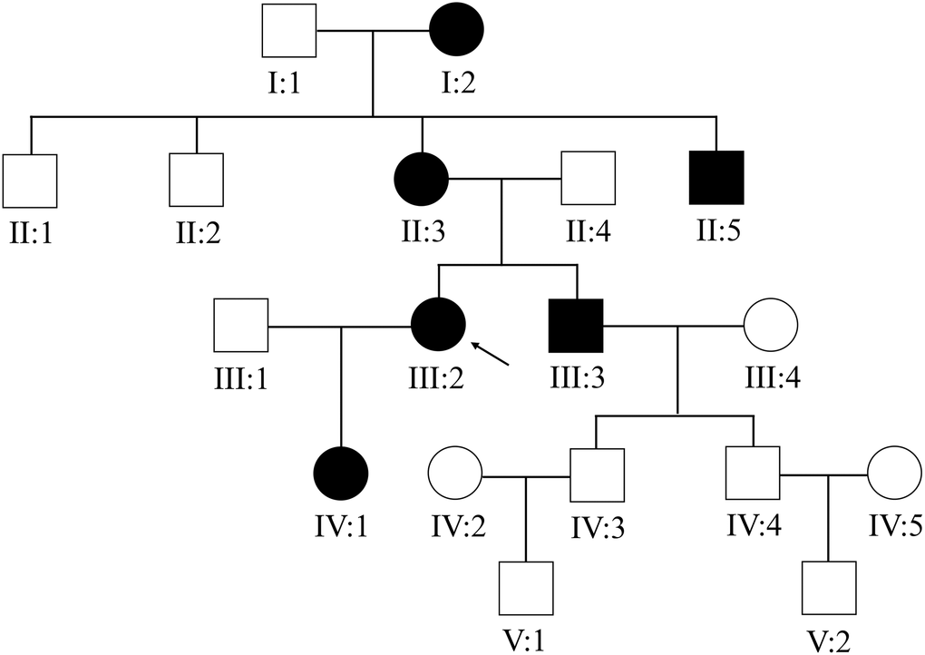 The Chinese family with primary angle-closure glaucoma. The pedigree of the five-generation Chinese PACG family is shown. Roman numerals indicate generations, and individuals within a generation are numbered from left to right. The proband (III:2) is denoted with an arrow.