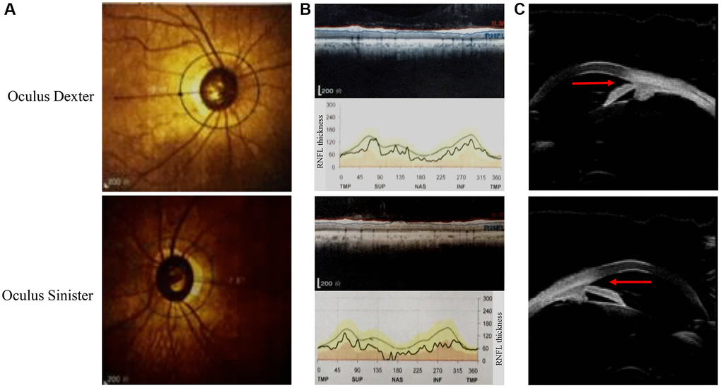 Ophthalmic examination of the proband in this pedigree. (A) The fundus angiography exam of the proband (III:2). (B) Retinal nerve fiber layer (RNFL) thickness is assessed by optical coherence tomography. (C) The results of ultrasonic biomicroscopy reveal relative pupillary block and a narrow-angle inlet.