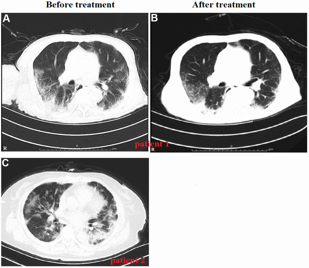 Variation in radiological findings in patients with severe and critical COVID-19 during disease course. Chest computed tomography (CT) shows severe multiple patchy shadows in both lungs on day 20 of symptom onset (examined upon admission) before treatment (A). Chest CT shows improved patchy shadows on day 39 of symptom onset for the same patient after treatment (B). Chest CT for a 68-year-old female who presented with high fever and dyspnea before treatment (C). Followed-up CT assessment was not performed because the patient died of her severe illness.