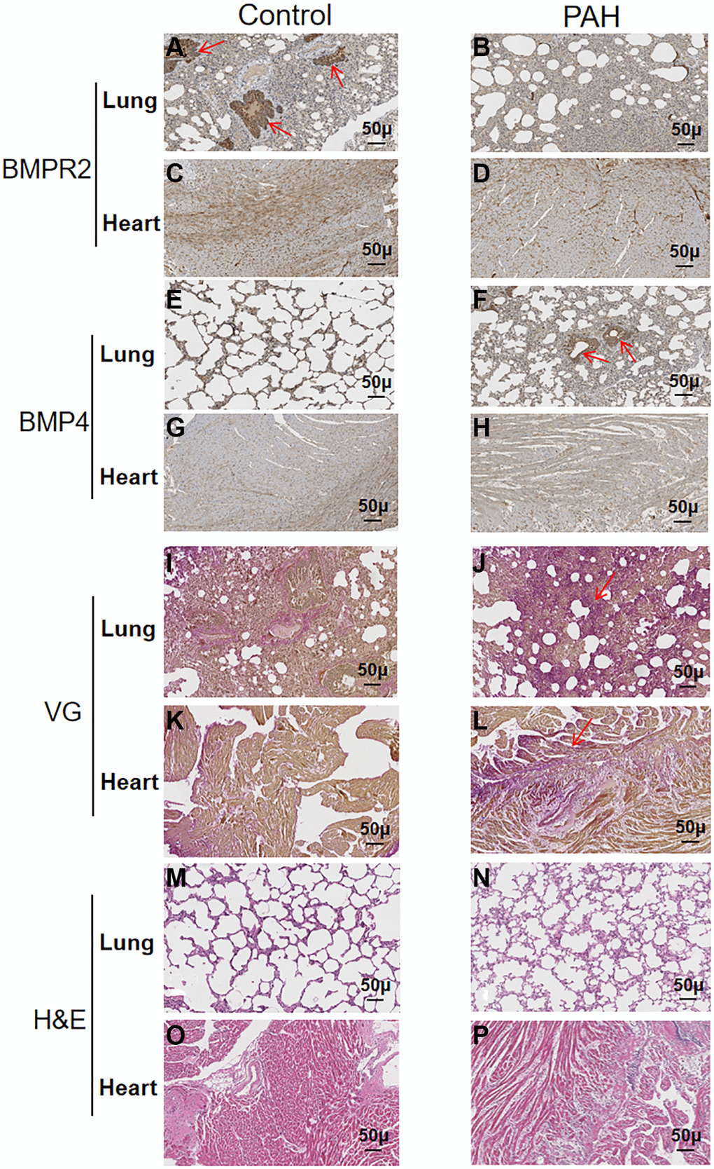 Reduced BMPR2 expression and higher fibrosis were observed in a pulmonary artery hypertension (PAH) mouse model. Abdominal shunt was used to create a pulmonary artery hypertension (PAH) mouse model. The lung and heart sections of 4 PAH mice were compared with those of 4 control mice. Scale bars, 50 μm. (A–D) BMPR2 expression was reduced on the lung section of the pulmonary hypertension model mice compared with that of the control mice based on immunohistochemistry staining. The brown stained areas indicated by the arrows in Figure 5A showed high BMPR2 protein levels in the lung section of the control mice. This reduction of BMPR2 was not observed in the heart sections comparing PAH mice with the control mice. (E–H) Higher BMP4 expression was observed on the lung section but not on the heart section of the PAH mice compared with the control mice by immunohistochemistry. The brown stained areas indicated by the arrows in Figure 5F showed high BMP4 protein levels on the lung section of the PAH mice. (I–L) Fibrosis was observed in the PAH mice. Van Gieson staining was carried out for the lung and heart section of the PAH and control mice. The area indicated by the arrow in Figure 5J and Figure 5L showed fibrosis on the lung and heart section of the PAH mice, respectively. (M–P) hematoxylin-eosin staining was carried out for the lung and heart section of the PAH and control mice.