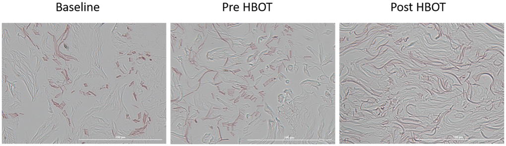 Elastic fiber changes. Following HBOT, there was a significant increase in elastic fiber numbers, along with a significant decrease in their fragmentation.